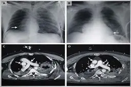 جا به جا شدن قلب یک مرد بر اثر تصادف! + عکس