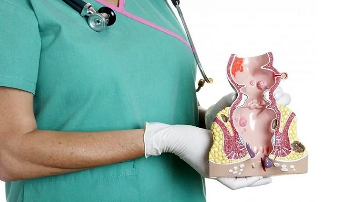 بواسیر را در خانه سه سوته درمان کنید