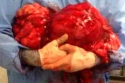 تومور شش کیلوگرمی  از شکم یک بیمار خارج شد