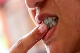 بهداشت نامناسب دهان از عوامل خطر ابتلا به این بیماری