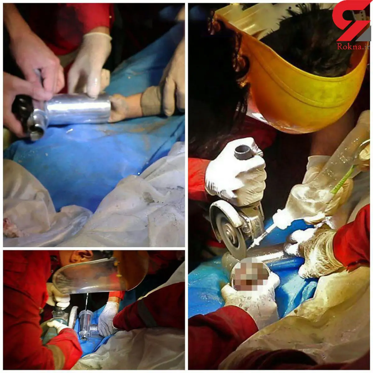 قطع شدن 4 انگشت یک کودک مشهدی + عکس های تکاندهنده
