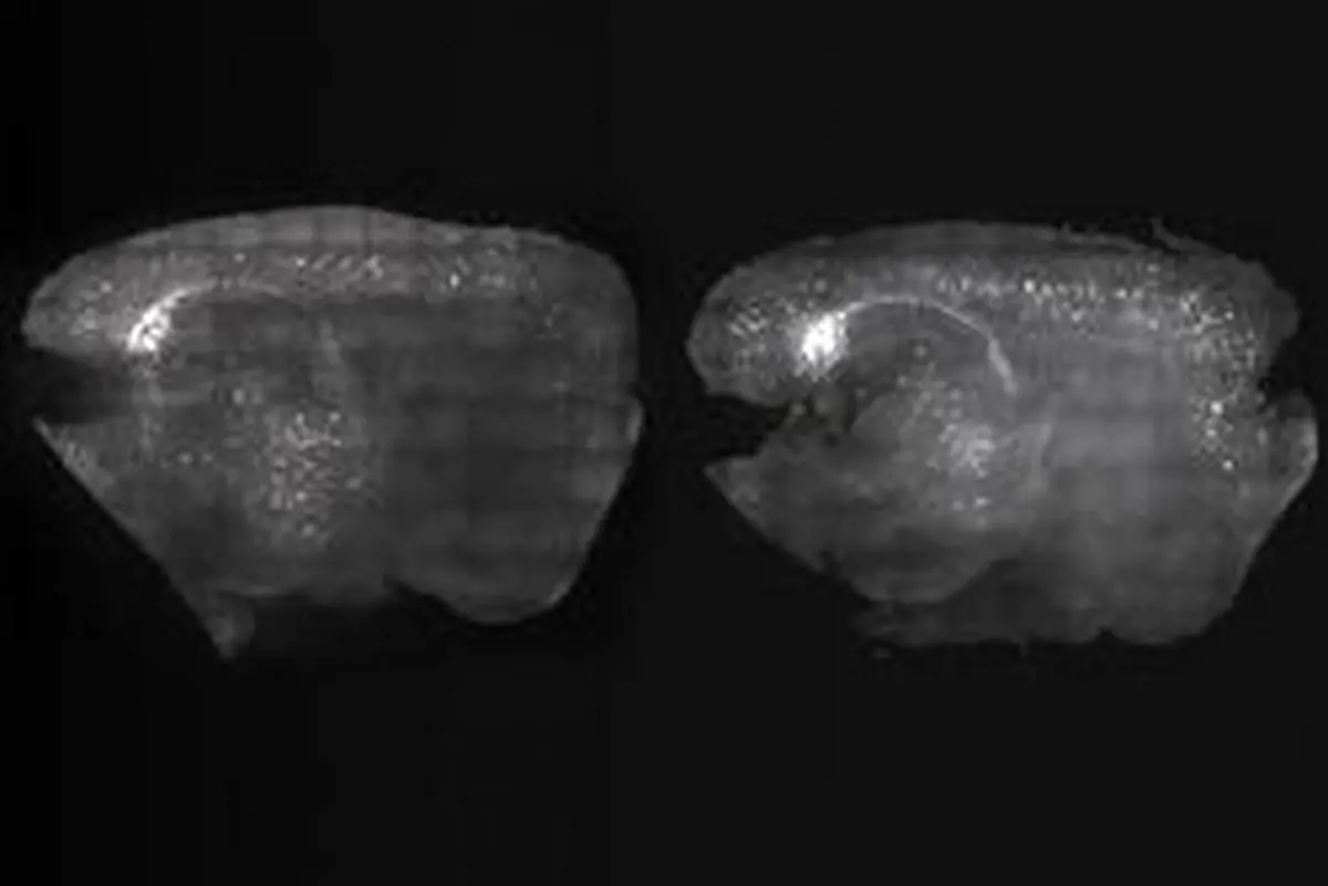 بهبود آلزایمر با کمک تحریک امواج مغزی