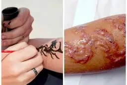 عاقبت وحشتناک خالکوبی با حنای سیاه روی دست دختر 7 ساله+عکس