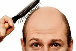 راهکار تعویق طاسی آقایان