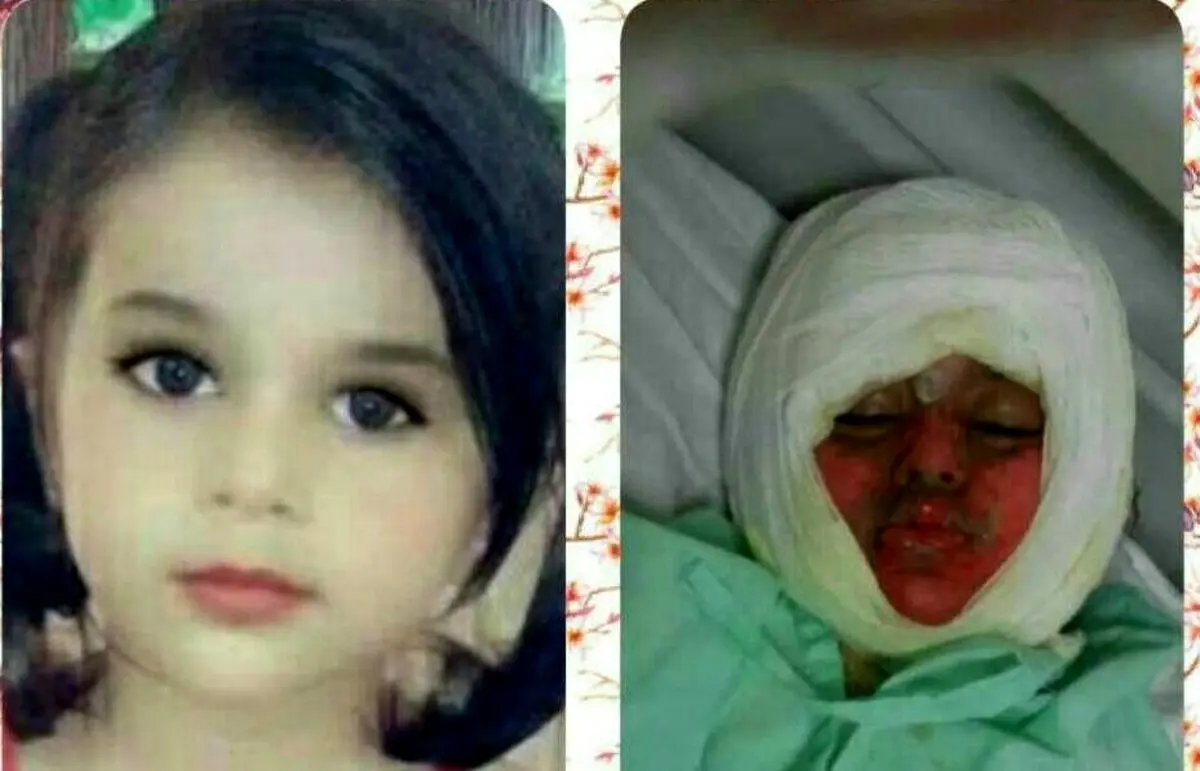 کودک 3 ساله در دیگ نذری سقوط کرد و سوخت +عکس