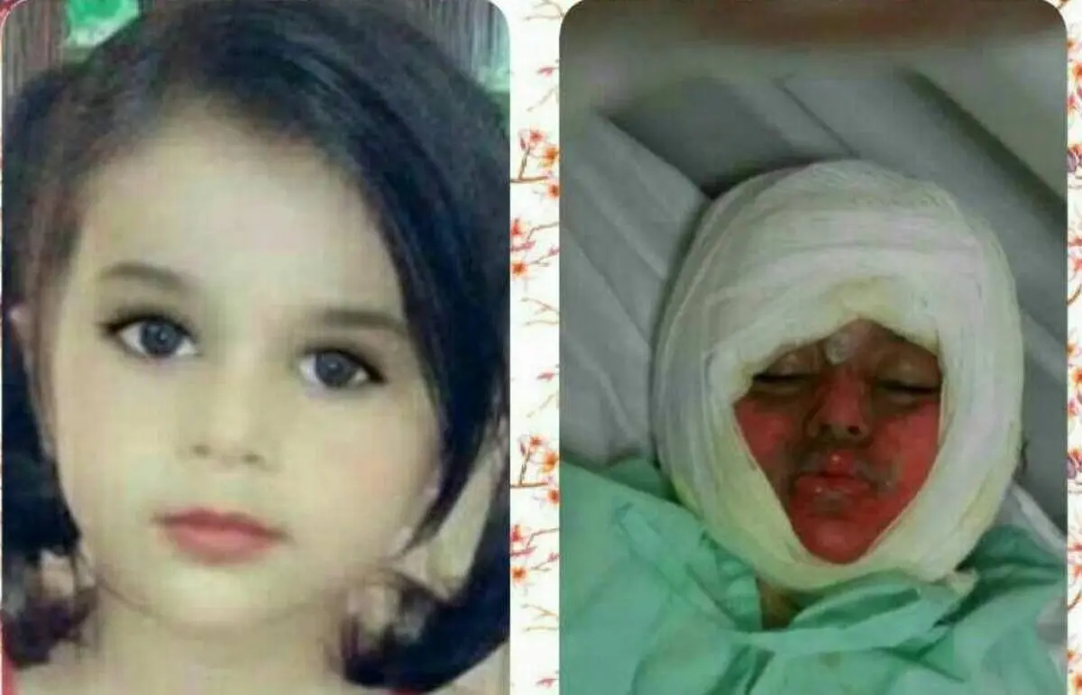 کودک 3 ساله در دیگ نذری سقوط کرد و سوخت +عکس