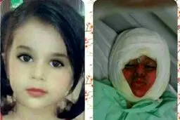 کودک 3 ساله در دیگ نذری سقوط کرد و سوخت +عکس