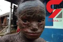 سرنوشت هولناک پسر ۱۰ ساله ای که پوست او را باید کند !+عکس