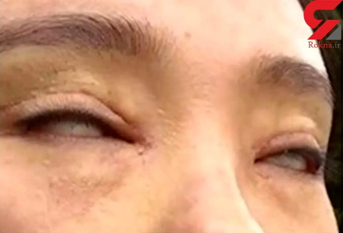 اتفاق عجیبی که بعد از جراحی زیبایی برای زن جوان رخ داد+ تصویر