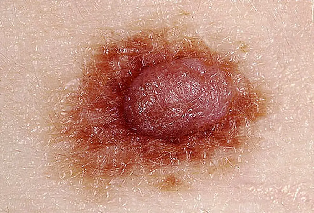 ۷ علامت هشدار دهنده در بدن که زنگ خطر ابتلا به سرطان هستند