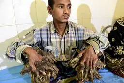 مرد درختی بنگلادش چطور عمل شد؟/عکس