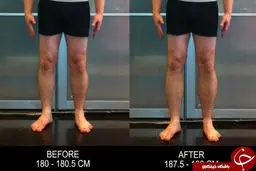 عمل جراحی عجیب برای قدبلند شدن +عکس