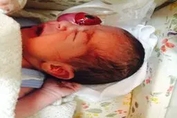 کودکی که باچشم از حدقه بیرون زده متولد شد فردا مرخص می شود + تصاویر