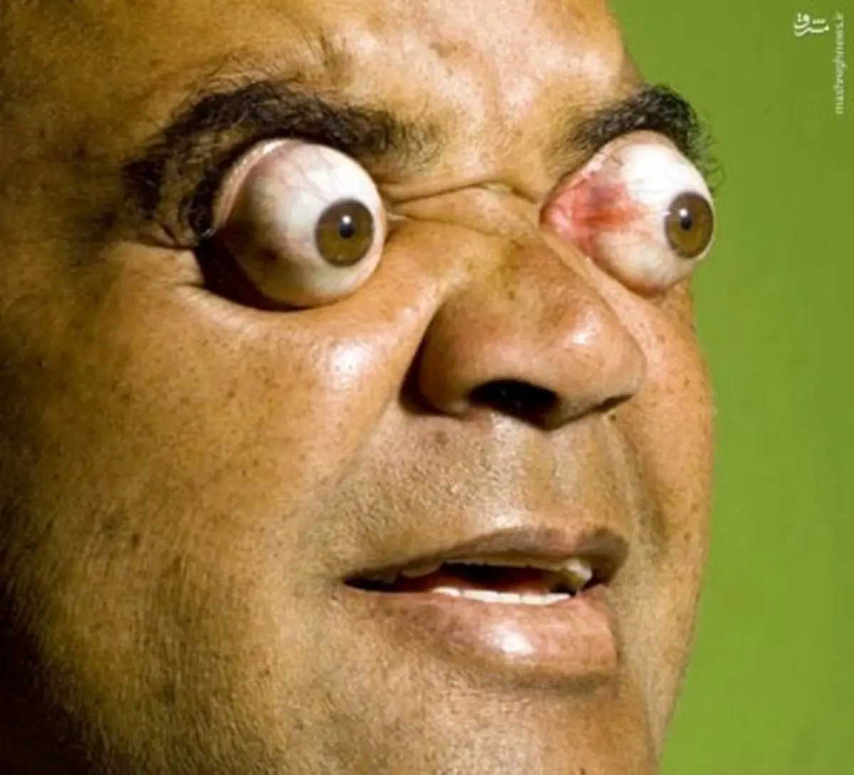 مردی که چشمانش را 4 سانتی متر بیرون می آورد/عکس