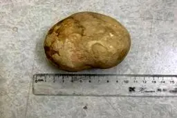 سنگ مثانه غول پیکر در بدن زن ویتنامی خبر ساز شد+عکس