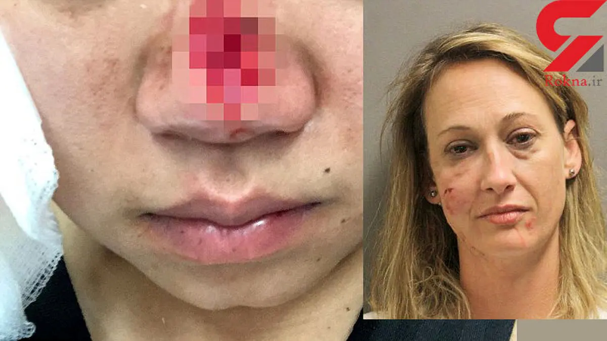 زنی در دعوا به طرز وحشیانه بینی زنی دیگر را با دندان کند و خورد+ عکس