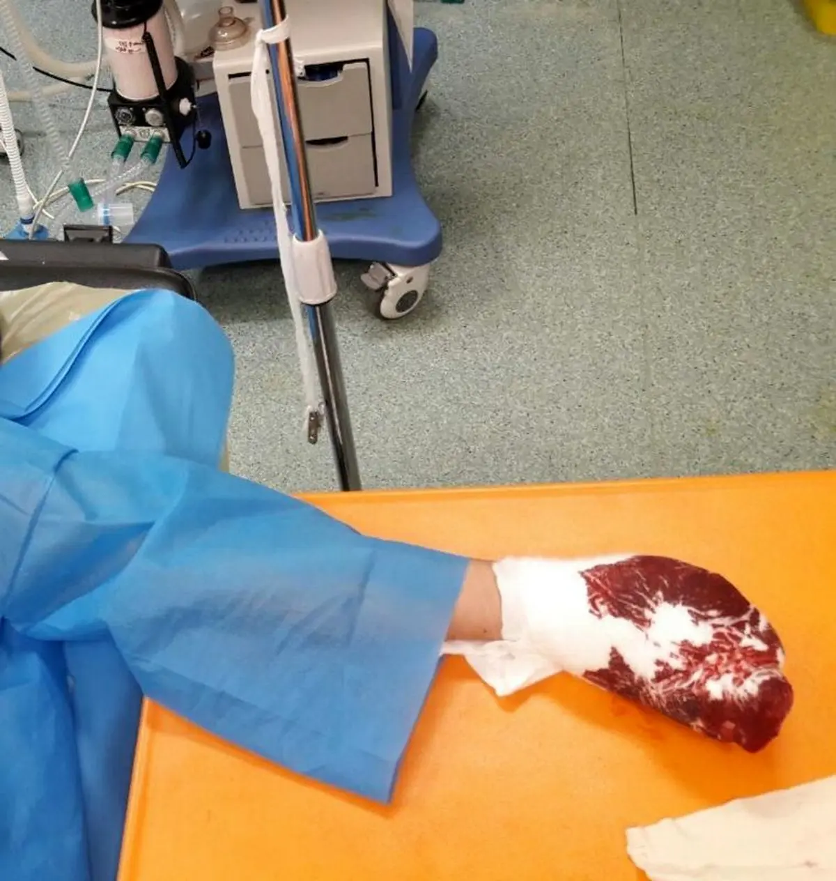 قطع انگشتان جوانی در چهارشنبه سوری (+عکس)