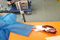 قطع انگشتان جوانی در چهارشنبه سوری (+عکس)