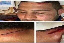 تصویری از زخم بزرگ پیشانی مهمترین شانس طلای کشتی آزاد در المپیک