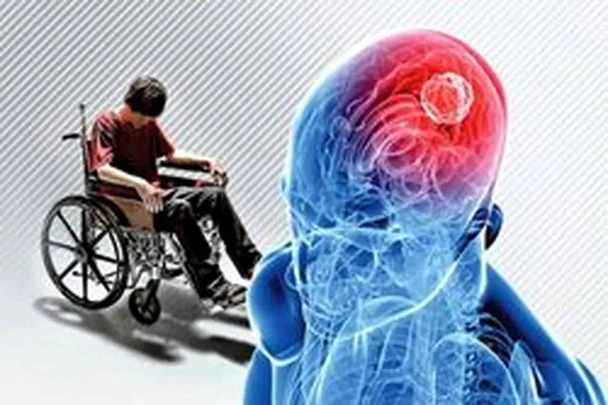 هر آنچه باید در مورد ام اس بدانیم + روش درمان
