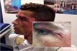 تصویری جدید از مصدومیت صورت کریس رونالدو