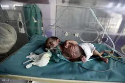 تصاویر دلخراش از گرسنگی کودکان در یمن