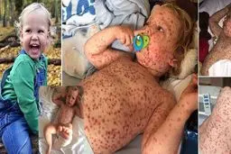 این کودک بدترین نوع آبله مرغان را گرفته است/عکس