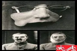 اولین پروتز بازسازی صورت/جنگ جهانی اول