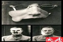 اولین پروتز بازسازی صورت/جنگ جهانی اول