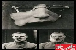 اولین پروتز بازسازی صورت/جنگ جهانی اول