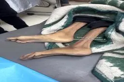  شهادت غم‌انگیز یک زن جوان در غزه بر اثر گرسنگی