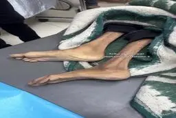  شهادت غم‌انگیز یک زن جوان در غزه بر اثر گرسنگی