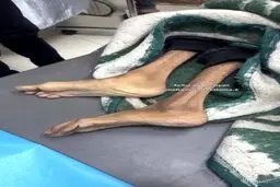  شهادت غم‌انگیز یک زن جوان در غزه بر اثر گرسنگی
