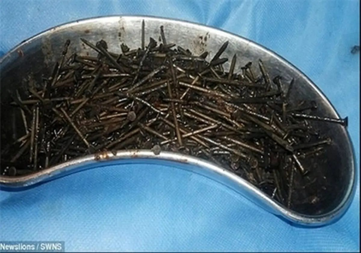 خارج کردن 639 میخ از شکم مرد هندی +عکس