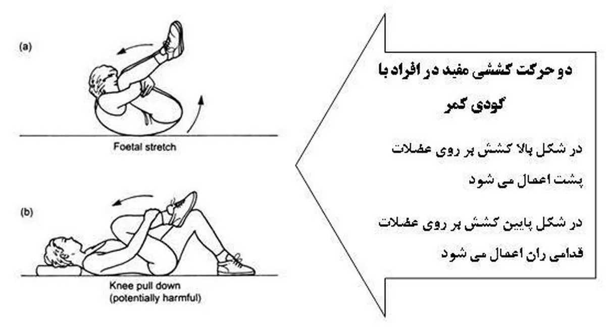 برای رفع گودی کمرتان چه باید بکنید؟