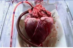 قلب زنده قبل از عمل پیوند+عکس