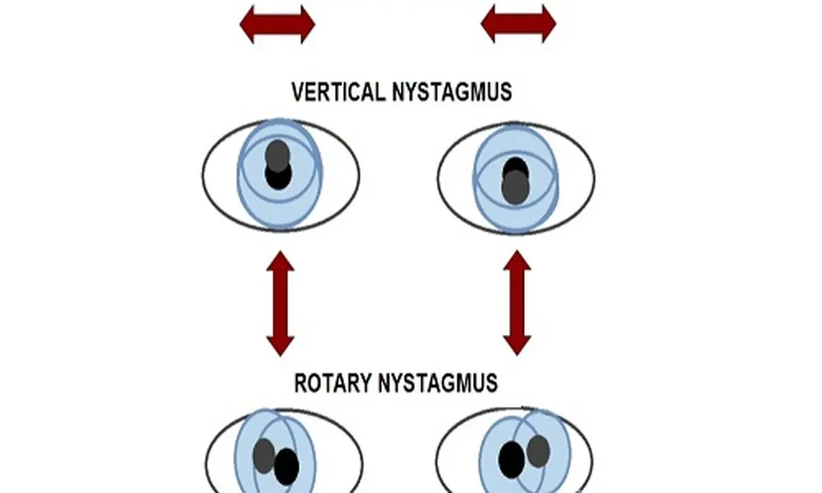 شایع ترین بیماری های چشم که احتمال ابتلا به آن زیاد است!
