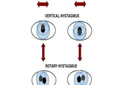 شایع ترین بیماری های چشم که احتمال ابتلا به آن زیاد است!