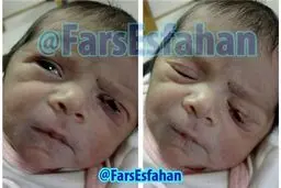 باز هم تیغ جراح پلک نوزاد را برید