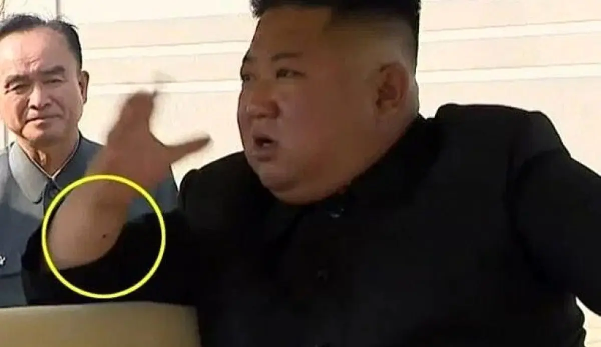 آثار عمل جراحی بر روی دست رهبر کره شمالی + عکس