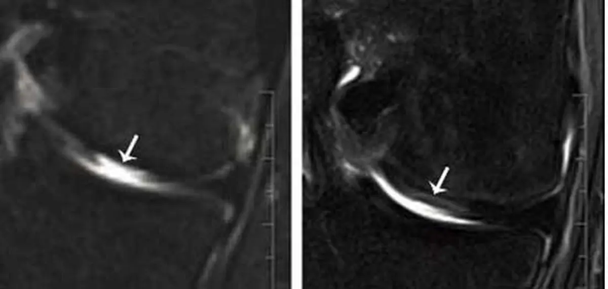 ترمیم مفصل زانو با کمک این قسمت از صورت+ عکس