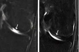 ترمیم مفصل زانو با کمک این قسمت از صورت+ عکس