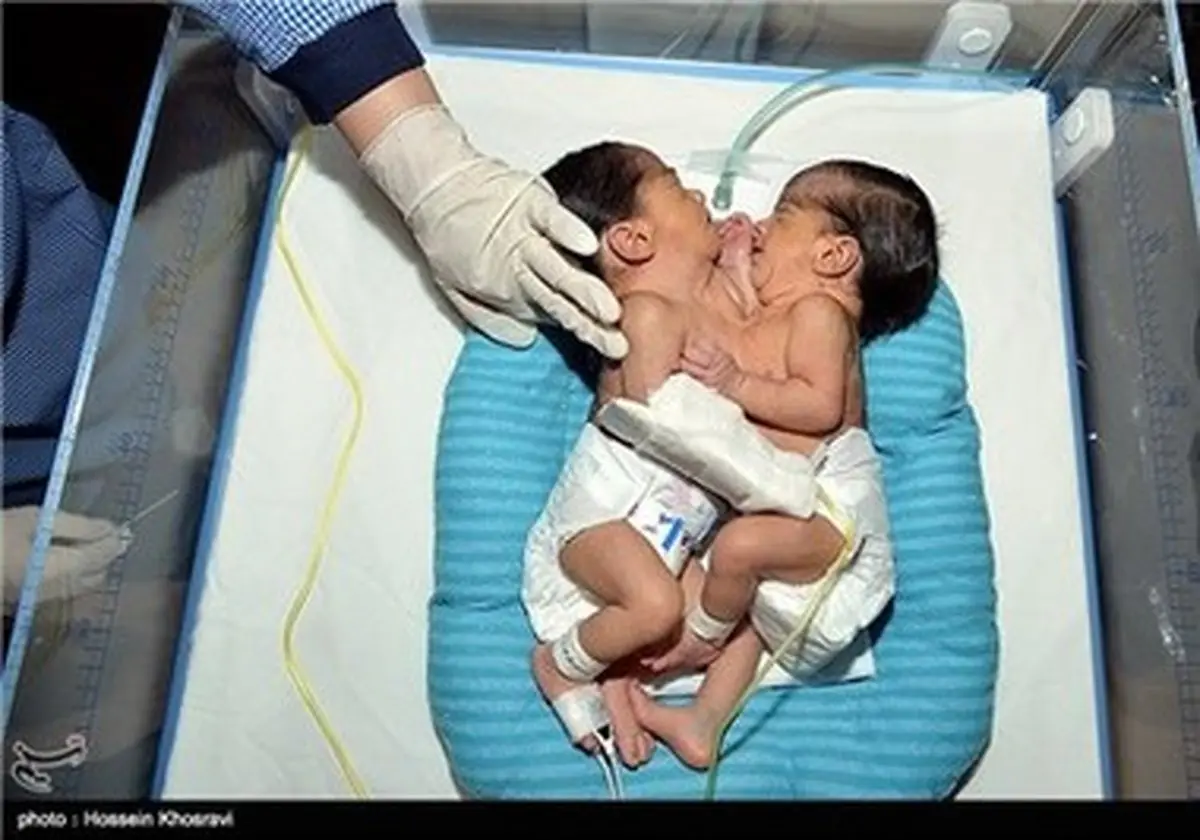 تولد دوقلوهای به هم چسبیده/ تصاویر
