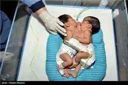 تولد دوقلوهای به هم چسبیده/ تصاویر