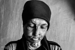 تصاویری تلخ از زیبایی های از دست رفته یک دختر 18 ساله