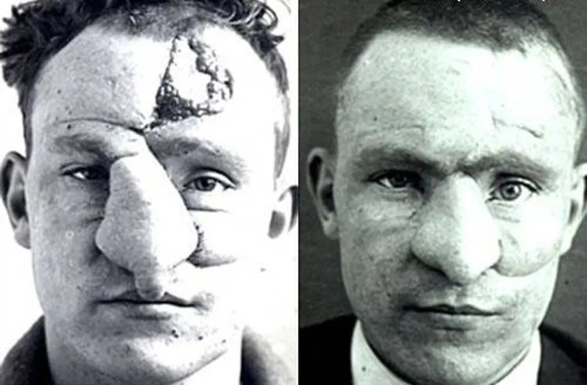 اولین جراحی پلاستیک در جهان/تصاویر