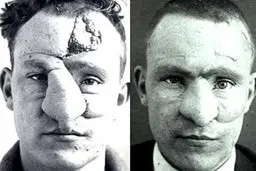 اولین جراحی پلاستیک در جهان/تصاویر