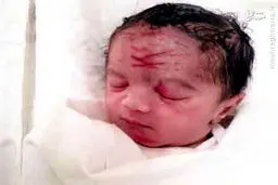 اشتباه وحشتناک پزشک هنگام سزارین/عکس