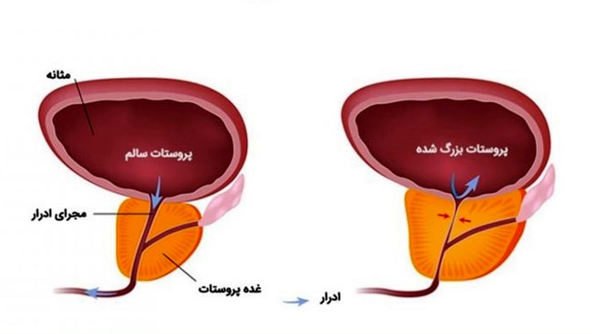 3 بیماری شایع در مردان ( از دیدگاه دکتر مجتبی عاملی اورولوژیست )