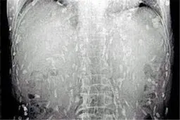 عاقبت خوردن سوشی/تصاویر